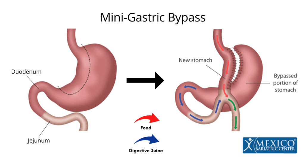 Understanding Mini Bypass Surgery For Effective Weight Loss