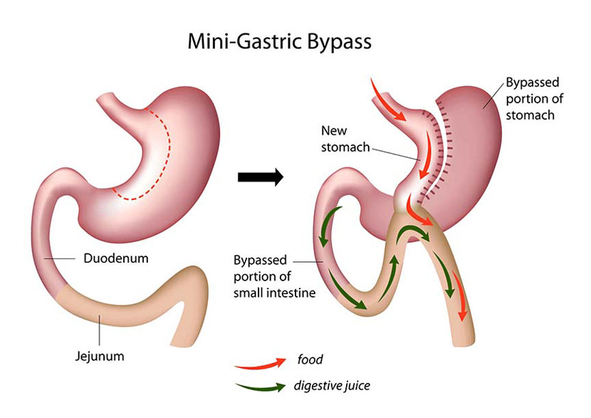 Understanding Mini Bypass Surgery For Effective Weight Loss